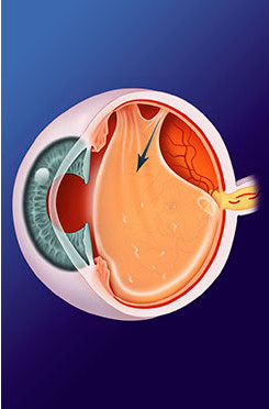 Retinal Tears, Vitreous Detachment and Floaters