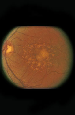 Age-related Macular Degeneration