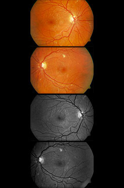 Diabetic Retinopathy