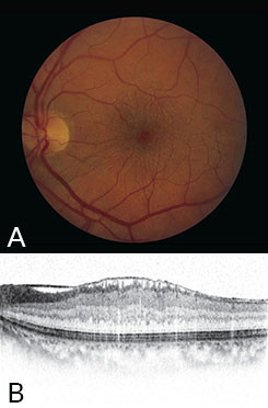 Epiretinal Membrane