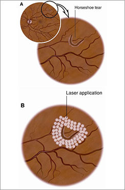 Laster Treatment 