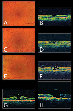 Macular Hole