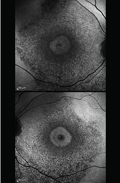 Placquenil Toxicity