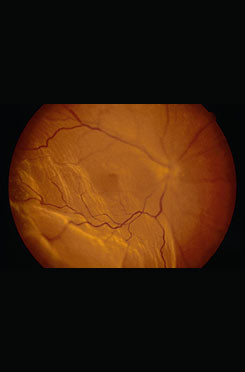 Retinal Detachment