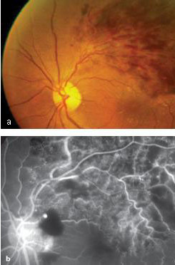 Vein Occlusions